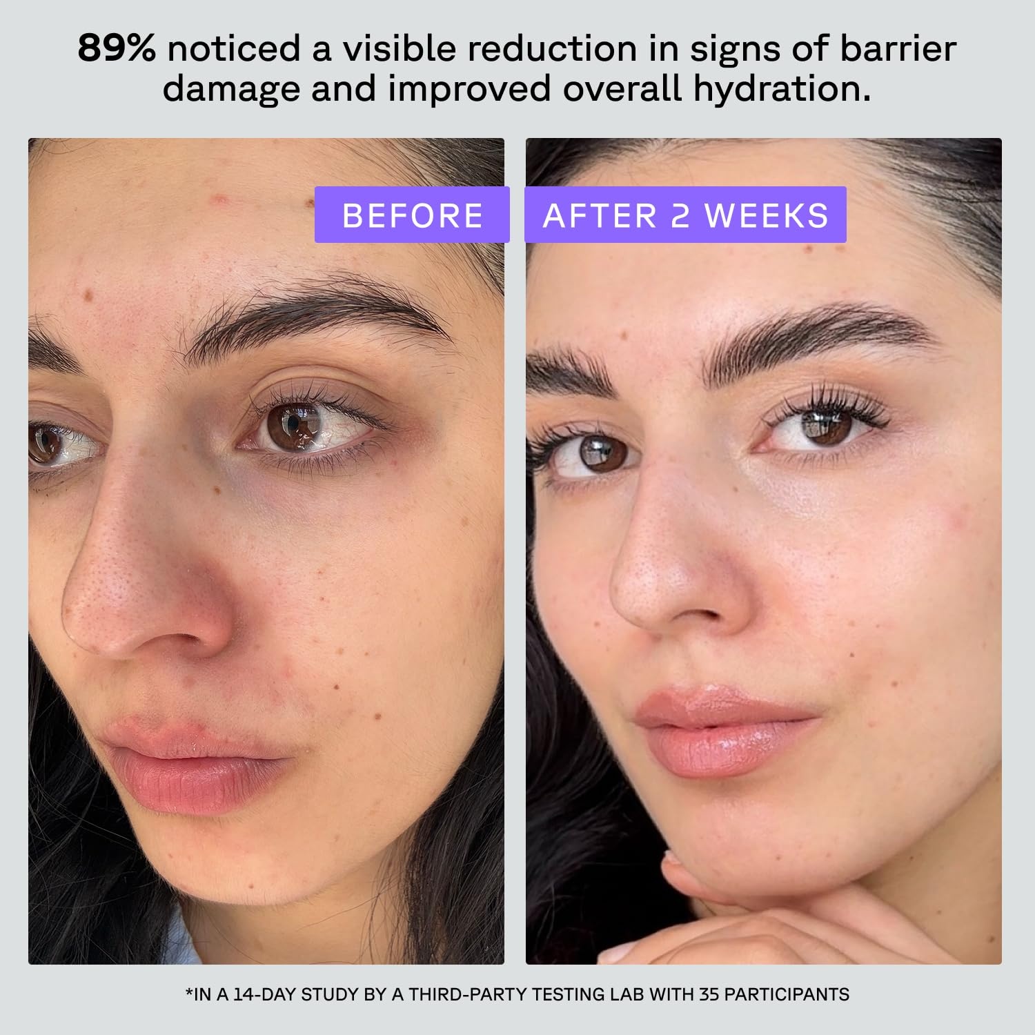 image:imageAcure Advanced Barrier Support Moisturizer Hydrating Facial Cream Complex Barrier Support for All Skin Types Contains Ectoin Plant Exosomes amp Ceramide Mesh Network 17 fl oz
