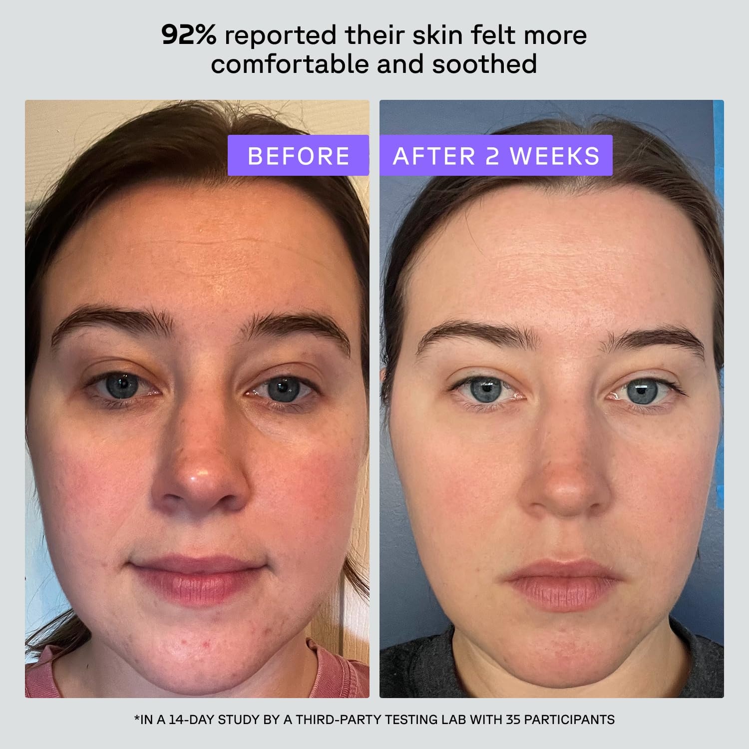 image:imageAcure Advanced Barrier Support Moisturizer Hydrating Facial Cream Complex Barrier Support for All Skin Types Contains Ectoin Plant Exosomes amp Ceramide Mesh Network 17 fl oz